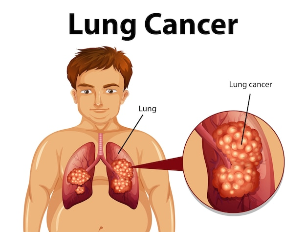 Lung Cancer: Symptoms, Risk Factors, Prevention, Diagnosis, Treatment