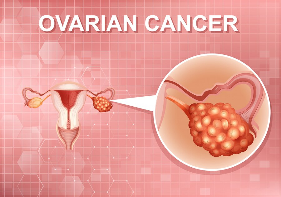 Ovarian Cancer: Types, Symptoms, Prevention, Diagnosis, Treatment