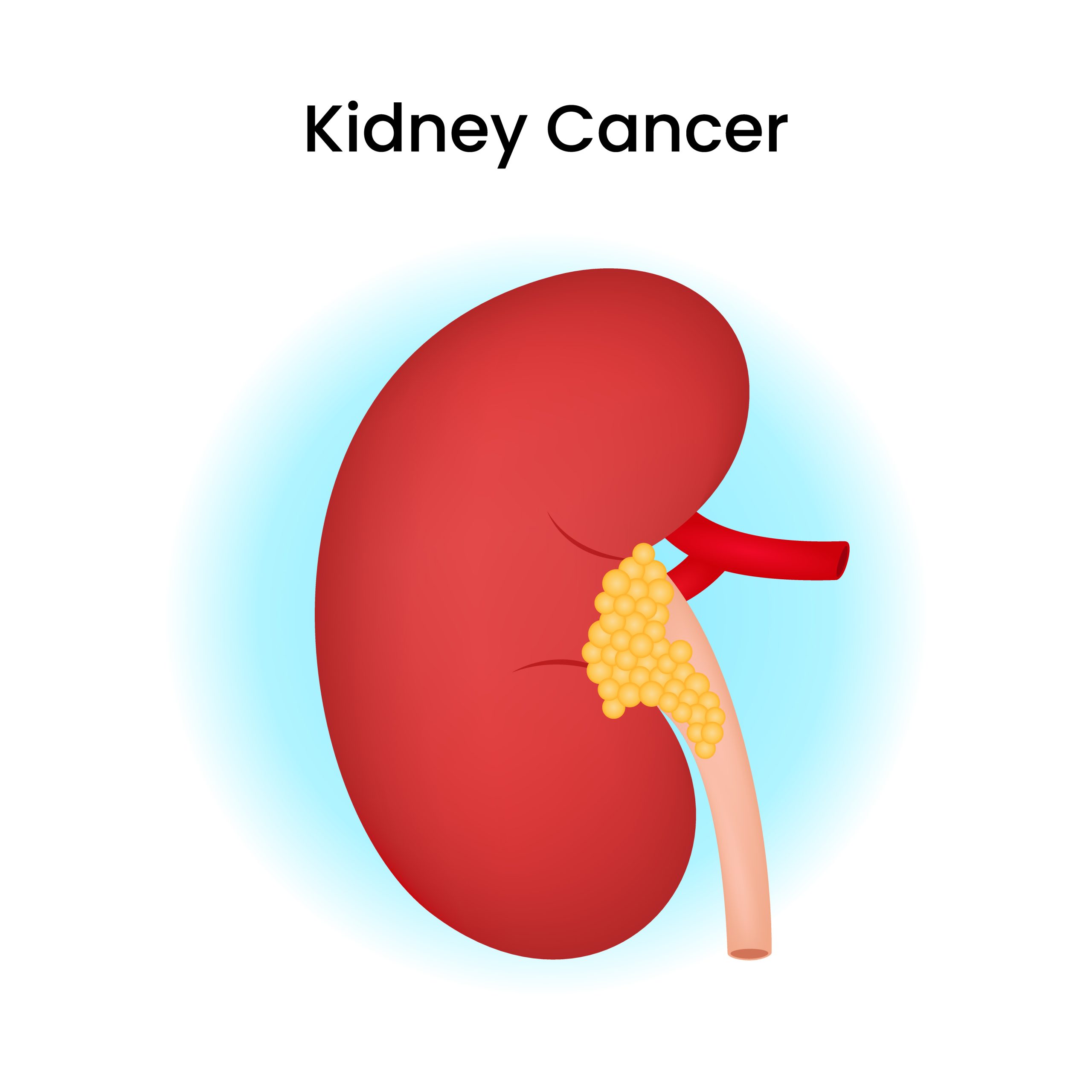 kidney cancer