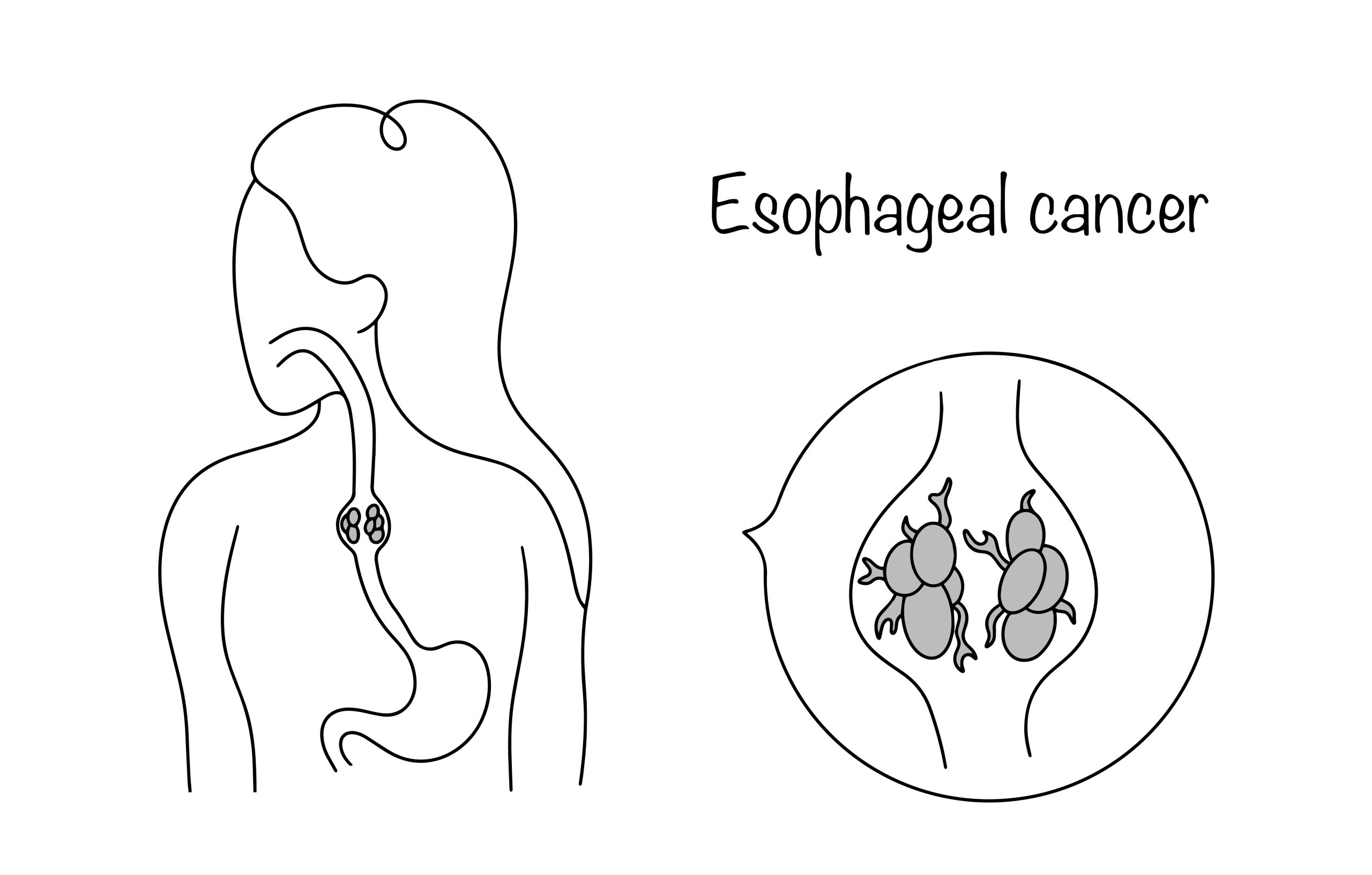 Esophageal cancer