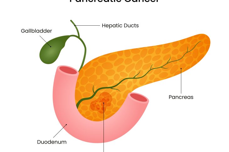 The Role of Diabetes in Pancreatic Cancer: Understanding the Connection