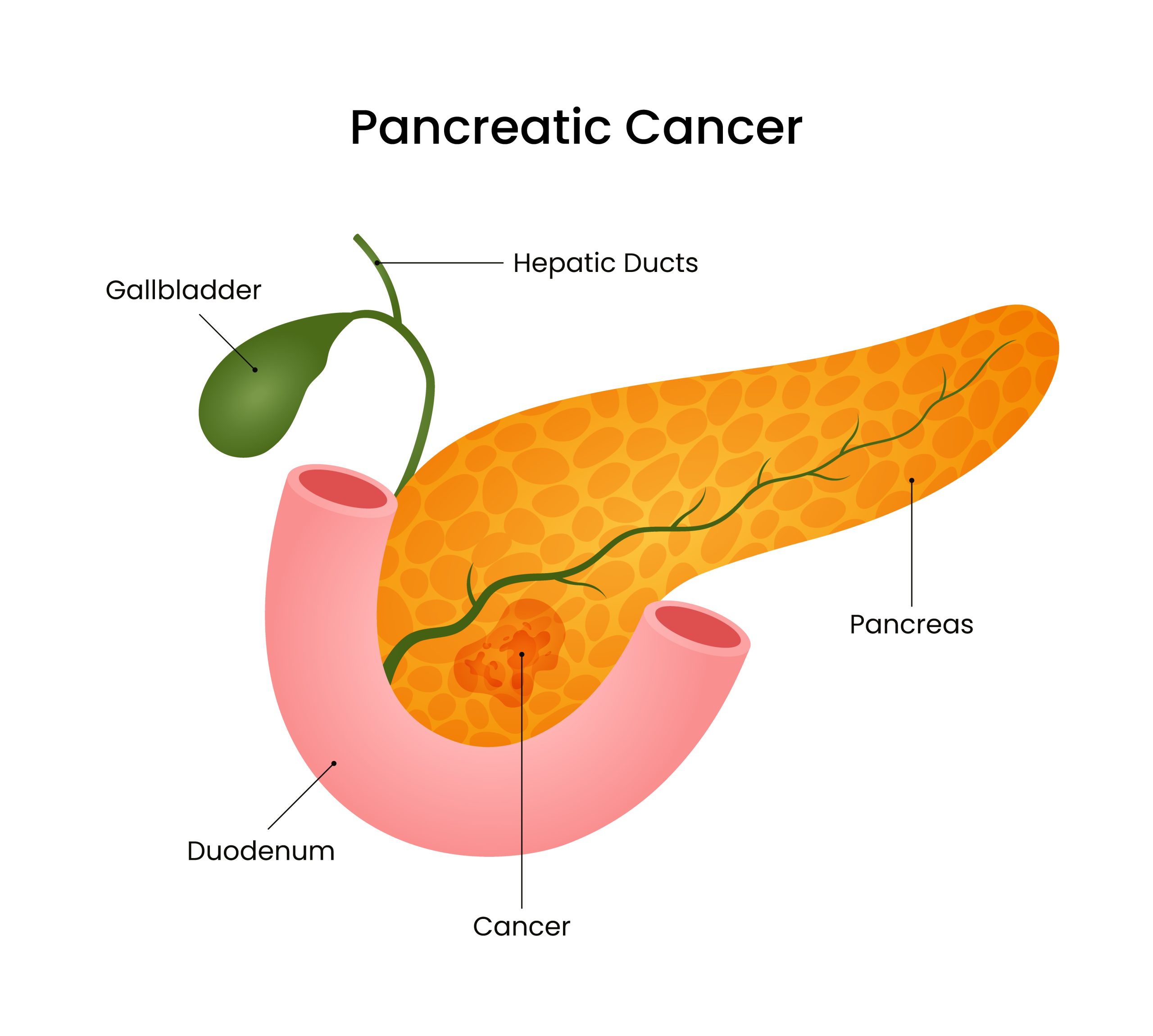 Pancreatic cancer