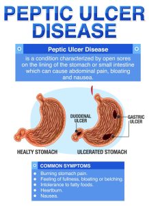 peptic ulcer