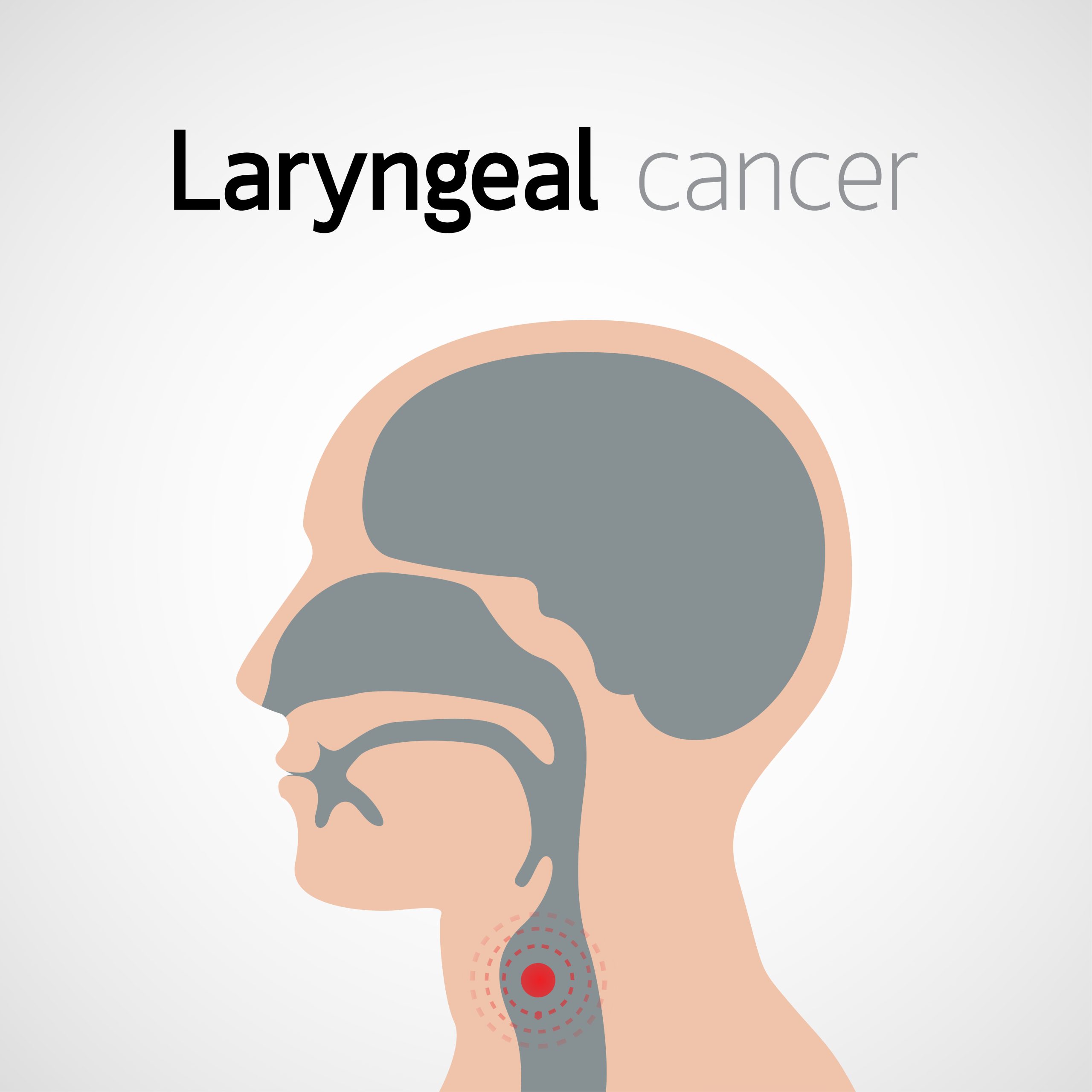 Understanding Laryngeal Cancer: Causes, Symptoms, Diagnosis, and Treatment