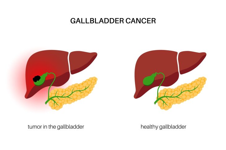 Understanding Gallbladder Cancer: Symptoms, Causes, Diagnosis, and Treatment