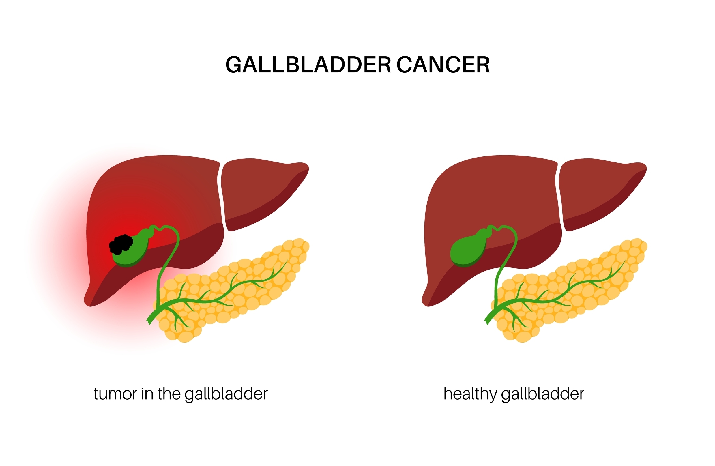 Understanding Gallbladder Cancer: Symptoms, Causes, Diagnosis, and Treatment