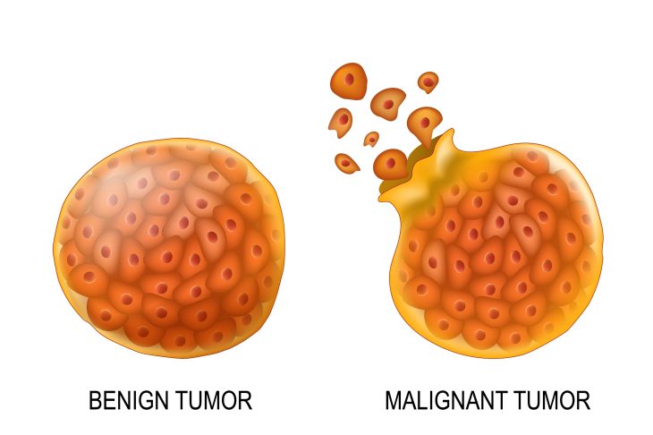 Benign vs. Malignant Tumours: Key Differences Explained