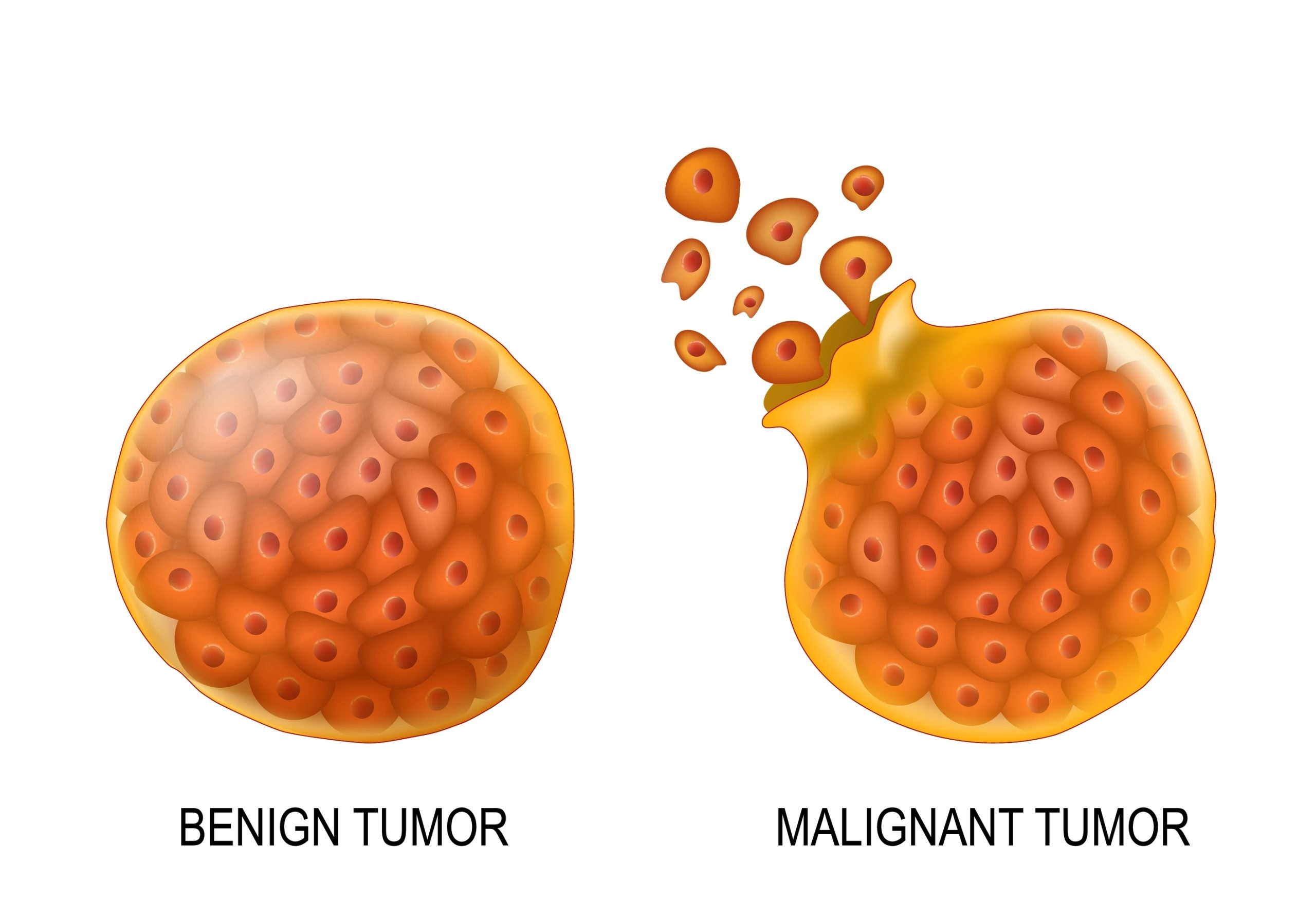 Benign vs. Malignant Tumours: Key Differences Explained