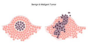 Benign and Malignant Tumours