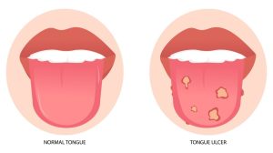 Tongue ulcer