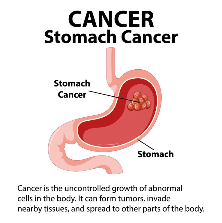 What is Stomach Cancer? Know More About It.